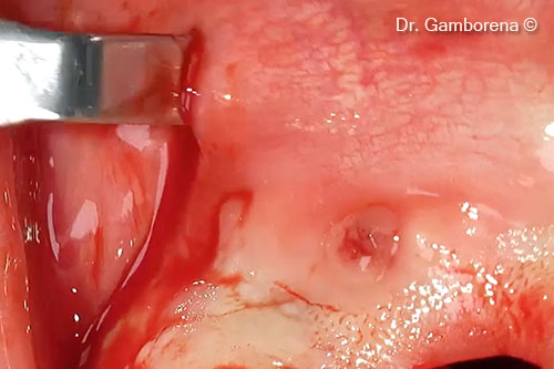 7. Flap management