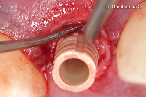 14. Circular position of the tCTG