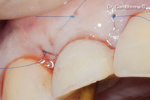 19. Final tCTG positioning and provisional restoration