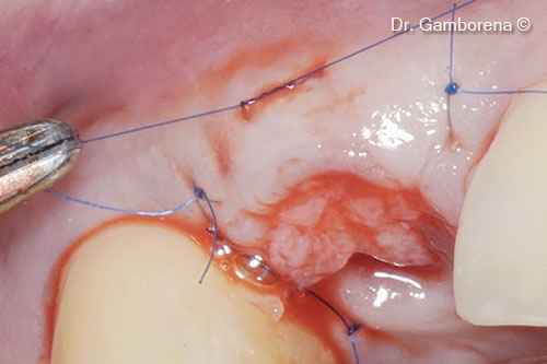 17. Second buccal and circular tCTG