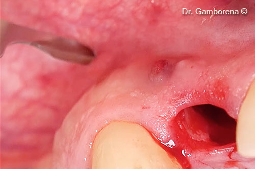 6. Incision to access to the granuloma