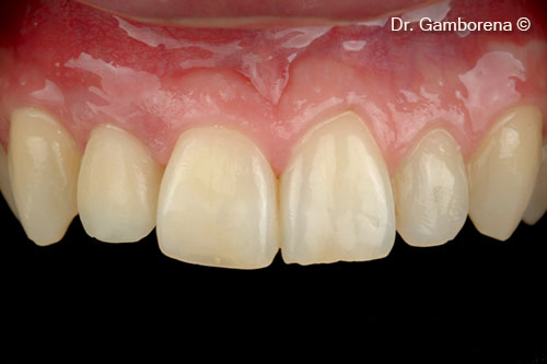 21. Second provisional restoration