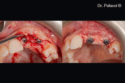 Second stage surgery 4 months later. Implants were still stable (ostell 74) and before soft tissue manipulation (Palacci flaps), GTO was added in a coronal position to gain in vertical.