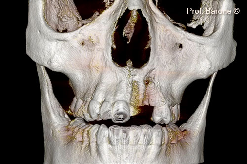 Teeth were lost (21 22 23). A significant portion of the labial bone was lost.