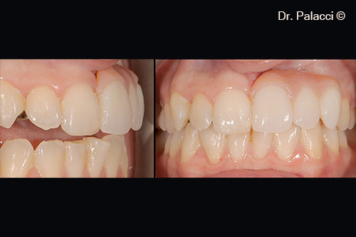 A temporary maryland bridge is placed. A large quantity of acrylic is placed to compensate tissue loss.