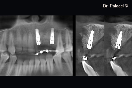 3D showing the graft and the implants placed.