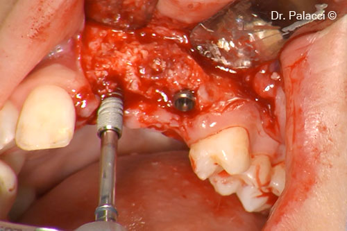 2 implants NP 3,5mm were placed and well stabilised (ostell value above 70)