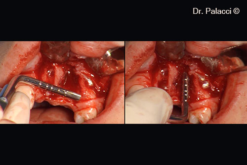 The entire labial plate of bone disappeared. Defect 16mm wide, 15mm height, 5mm depth.