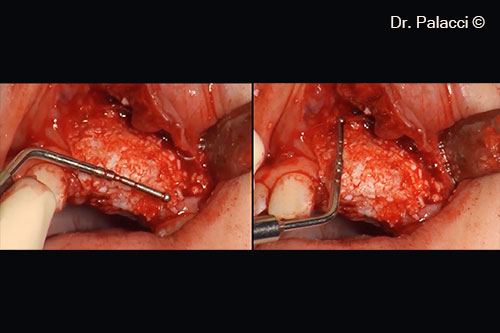 The entire labial plate of bone disappeared. Defect 16mm wide, 15mm height, 5mm depth.