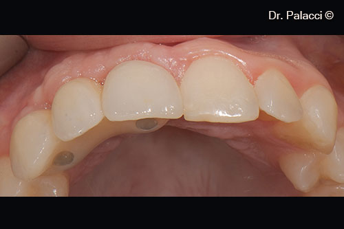 Occlusal view. Notice the vertical and horizontal gain in tissues.