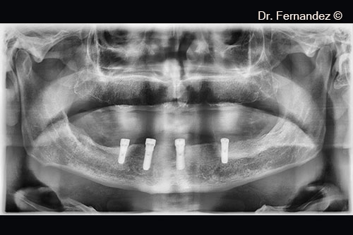 Radiological control, 3 months later.