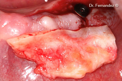 Connective tissue graf.