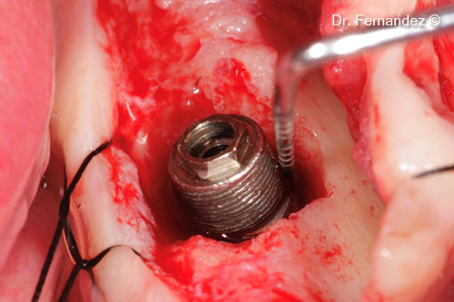 Cleaning and decontamination of the peri-implant defect and the implant surface.