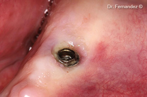 Initial situation with purulent exudate and deficit of keratinized gingiva.