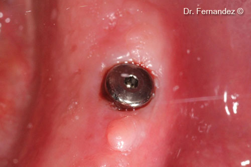 Clinical situation, 3 months later.