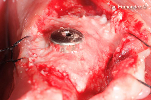 Filling of the peri-implant defect with OsteoBiol Putty.