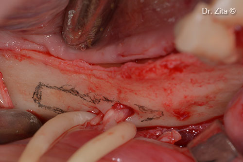 Mental Nerves retracted with yellow sterile rubber and designed window for exposing inferior alveolar and incisive nerves, with grey sterile pencil