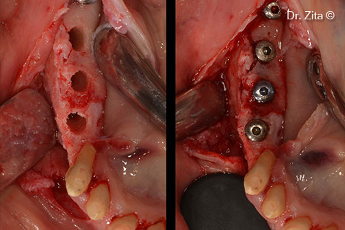 Placing of extra 3 implants on the regenerated ridge