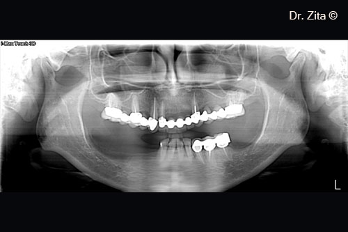 Initial panoramic X-Ray showing the mental foramen near the bone ridge