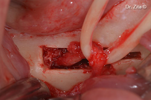 Retrieving the IAN nerve from his canal after cutting the incisive part of the nerve 3 mm in front of mental nerve (IAN transposition)