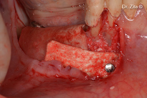 Cortical lamina in place after placing some putty biomaterial between the sticky bone and the cortical lamina . The lamina was also stabilized by a metallic pin and with sutures