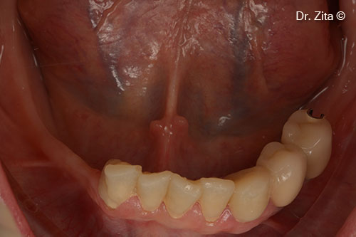 Initial clinical photographic intra oral situation