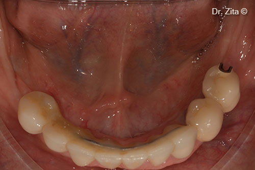 After 6 months of healing of the horizontal ridge augmentation