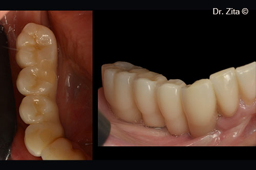 Panoramic X- ray with all implants placed