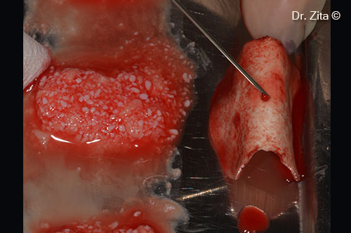 mp3 mixed with autologous bone (plate from the window that was milled with bone mill) and I-PRF and curved soft cortical lamina from Osteobiol with I-PRF