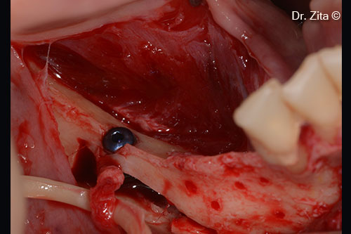 Decortication of bone that needs to be regenerated horizontally, mesially to transposed IAN