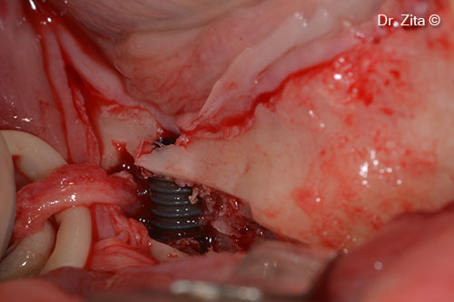 Implant placed in front of new position of transposed IAN