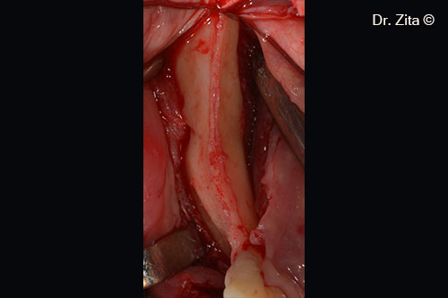 Bone Ridge exposed after full thickness raised flap and incision with 15c scalpel blade