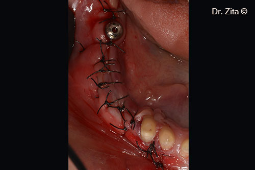 Non resorbable sutures supramid 4(0) to close the operatory wound