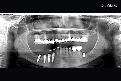 Final Rehabilitation with metalo - ceramic crowns . Case with 7 years of follow up