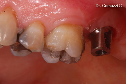 Implant Abutment