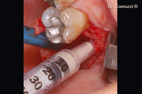 Transcrestal Sinus floor Elevation