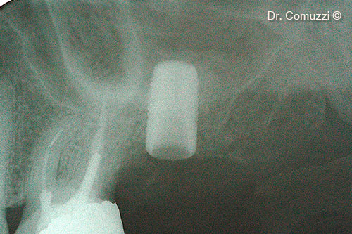 Rx of Sinus Lift at Implant placement