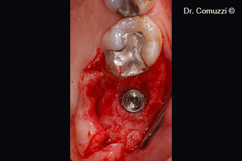 Implant position at crest