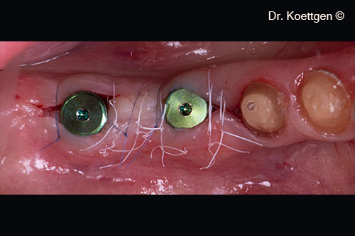 Connective tissue graft between 46 and 47