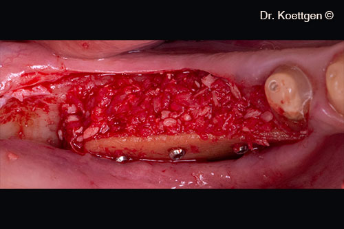 60% autogenous bone 40% Apatos was grafted between the pristine bone and Cortical Lamina