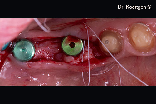 Connective tissue graft was used to thicken the soft tissue around implants