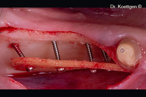 Reconstruction of an atrophic mandible