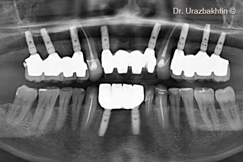 Final x-ray after 8 years