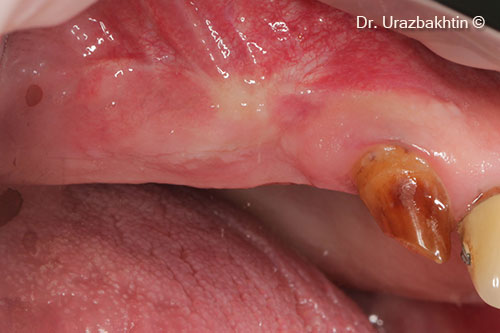 Intraoral view after 4 months