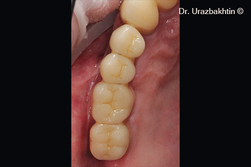 View of orthopedic structures 8 years post-op