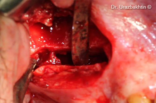 Osteotomy of the jaw ridge