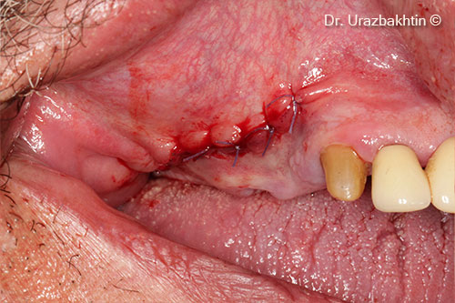 Augmentation using the inlay bone graft technique