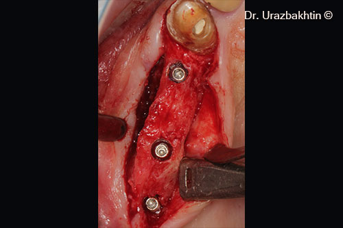 Installation of Astra Tech TX dental implants