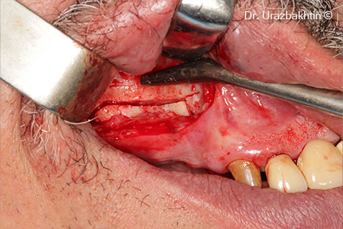 Osteotomy of the jaw ridge