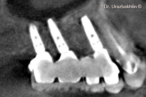 X-ray 3 years post-op